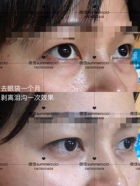 祛眼袋一个月