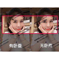 卧蚕剥离