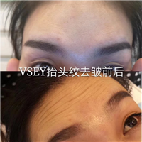 无针医美|无针医美是什么