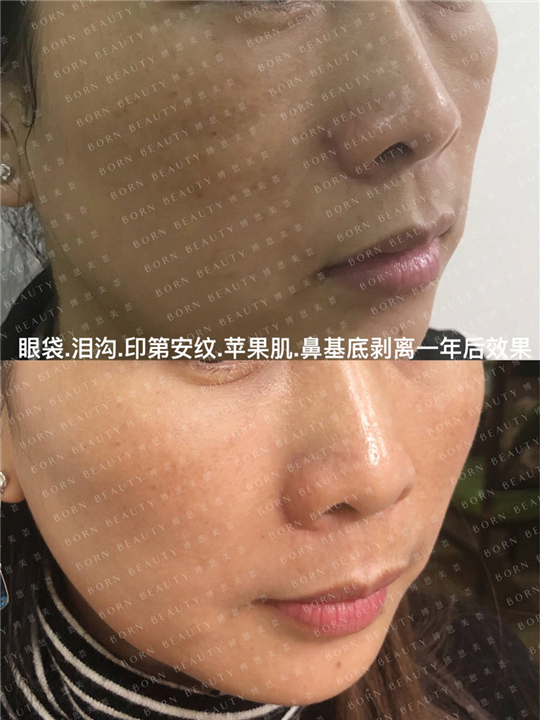 泪沟眼袋印第安纹苹果肌鼻基底剥离一年后效果