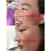无针医美是什么|VSEY无针微整形培训