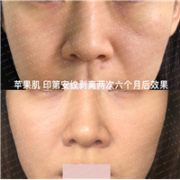 苹果肌印第安纹剥离两次六个月后效果