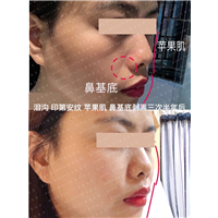 泪沟印第安纹苹果肌鼻基底剥离三次半年后