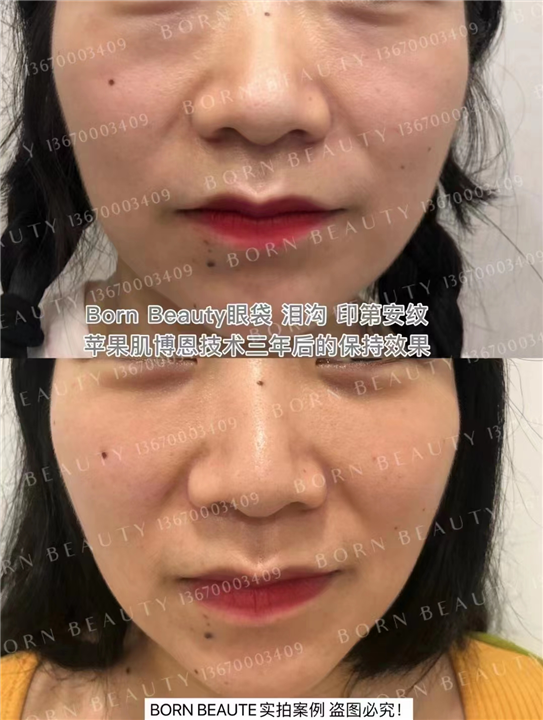 印第安纹剥离技术真的有那么好吗？手术有风险吗？