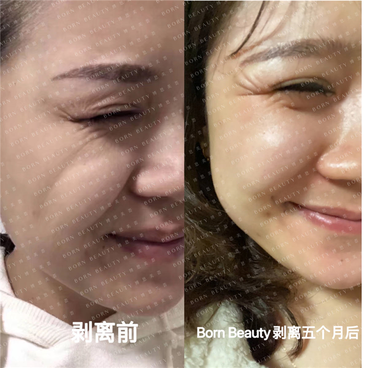 印第安纹剥离五个月后