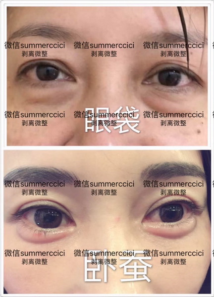 眼袋卧蚕剥离
