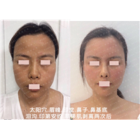 泪沟印第安纹苹果肌剥离两次后