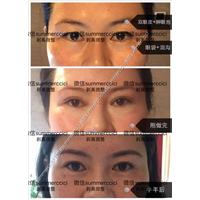 博恩汇美剥离双眼皮