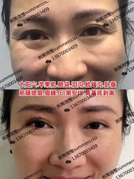 太阳穴苹果肌眼袋剥离