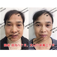 眼袋泪沟八个月