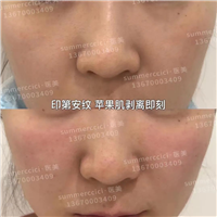 印第安纹剥离技术有风险吗？