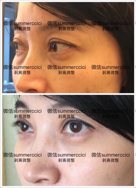 博恩汇美剥离