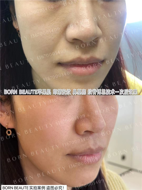 印第安纹填充胶原蛋白和玻尿酸哪个好？还有其他方式吗？