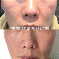 印第安纹苹果肌剥离两次七个月后