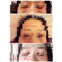 眼袋刚刚做好