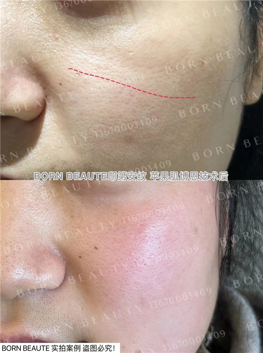 印第安纹怎么才能消除？30岁女人长有印第安纹怎么办？