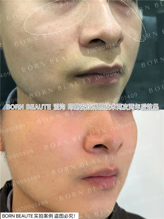 印第安纹怎样才能有效的淡化？只有剥离的方式才管用？
