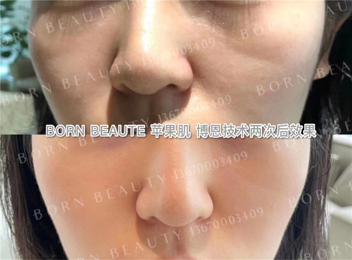印第安纹填充用什么分子好？印第安纹可以打玻尿酸吗？