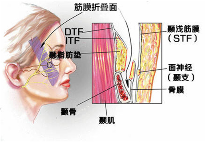 筋膜折叠去除印第安纹效果好吗？印第安纹多久彻底恢复好？