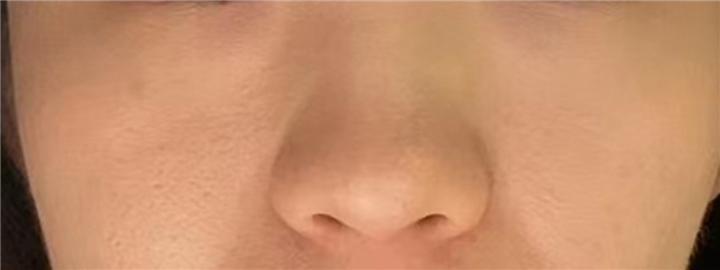 印第安纹等级自测，这种等级的印第安纹需要尽早解决