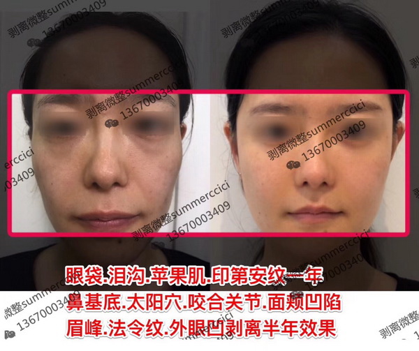 眼袋泪沟苹果肌印第安纹剥离一年