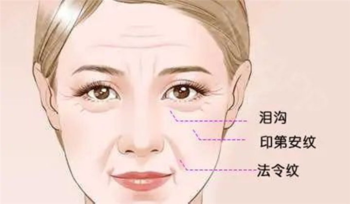 因长胖而出现的印第安纹瘦了会消失吗