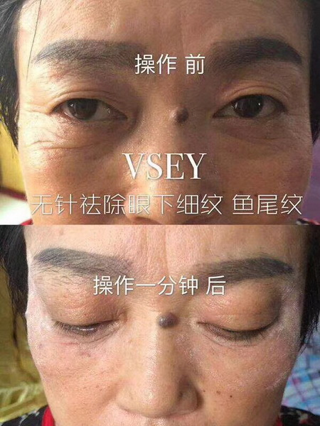 无针医美是什么|VSEY无针微整形培训