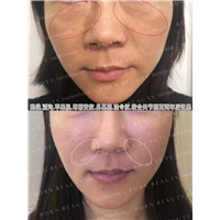 哪种医美技术能够有效去除印第安纹？副作用小的技术是什么？