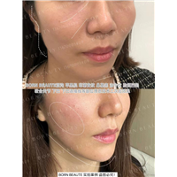 印第安纹一次医美可以维持几年？如何选择？