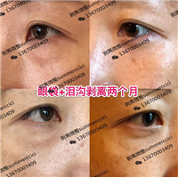 眼袋泪沟剥离两个月