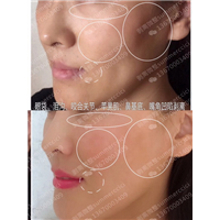 眼袋泪沟咬合关节剥离