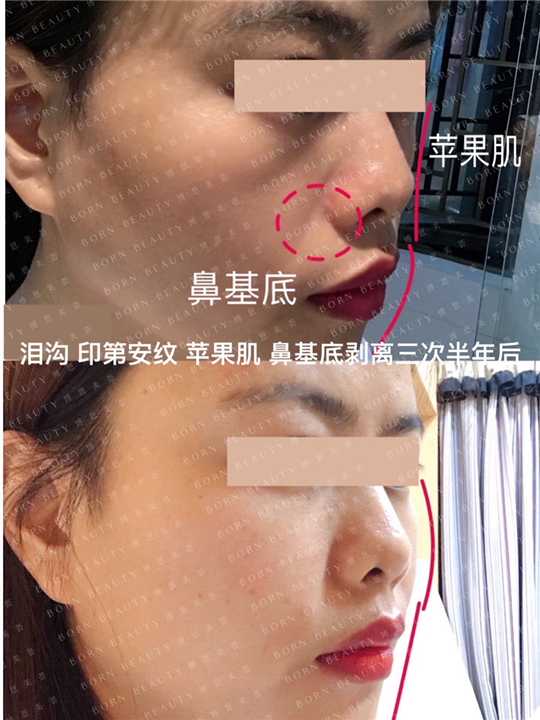 泪沟印第安纹苹果肌鼻基底剥离三次半年后