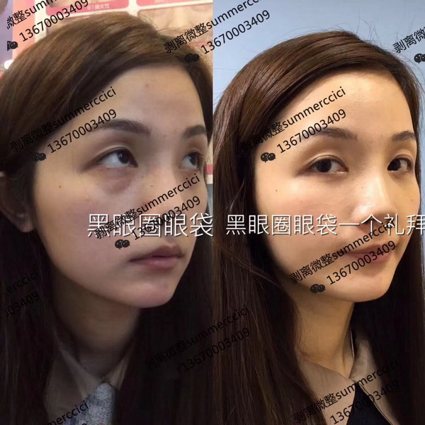 黑眼圈眼袋一个礼拜