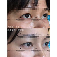 祛眼袋一个月
