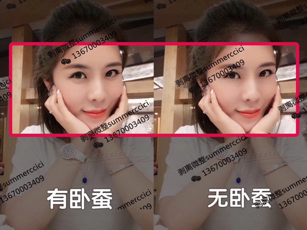 卧蚕剥离