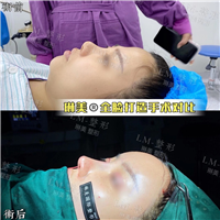 琳美整形鼻综合整形 