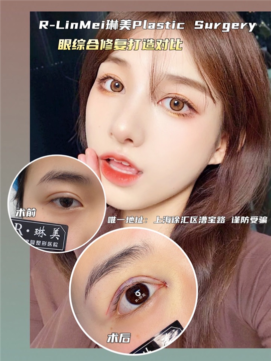 琳美整形眼综合整形 