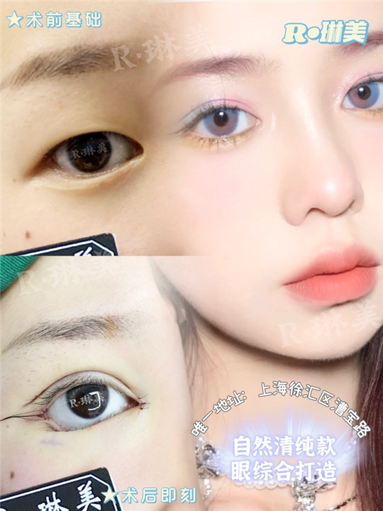 琳美整形眼综合整形 
