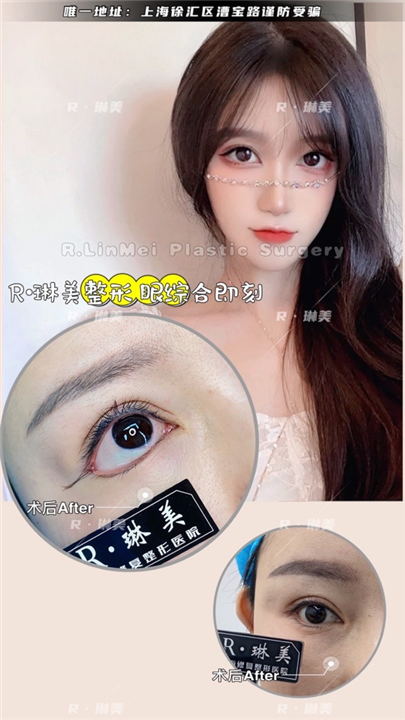 琳美整形眼综合整形 