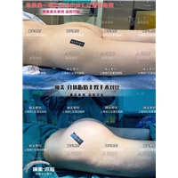 上海琳美丰臀整形