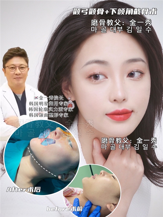 上海磨骨整形医院 