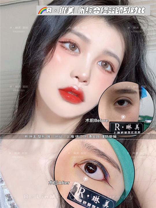 琳美整形眼综合整形 