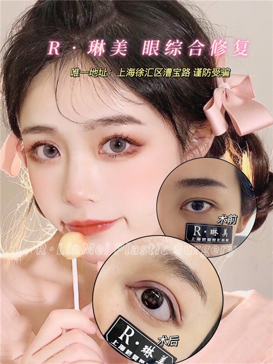 琳美整形眼综合整形 