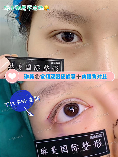 上海琳美眼综合整形