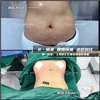 琳美吸脂整形