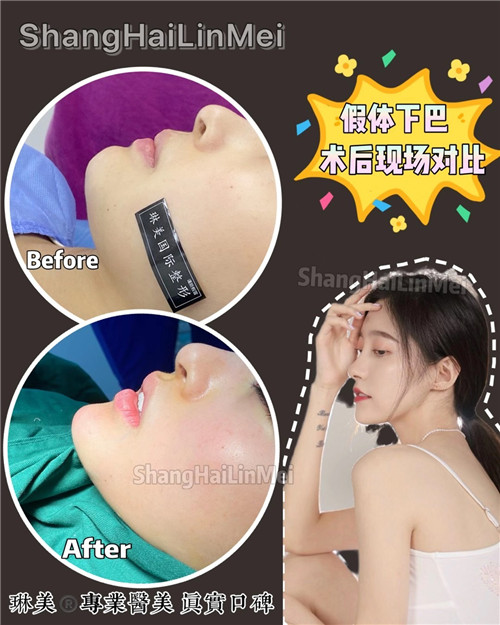 上海琳美下巴整形