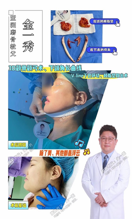 上海磨骨整形 