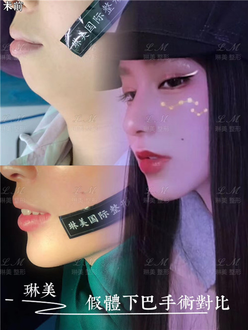 上海琳美下巴整形