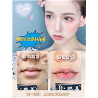 琳美唇部整形