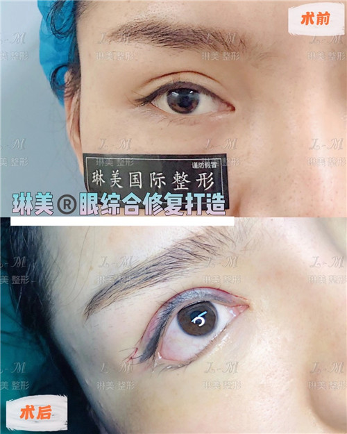 上海琳美眼综合整形